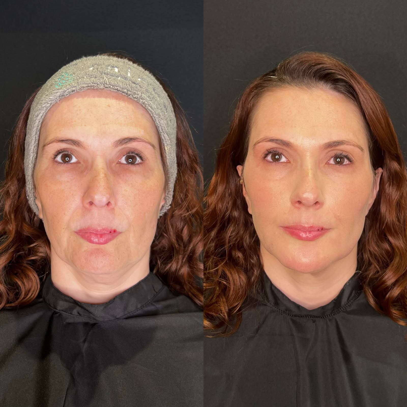Resultado real de paciente: comparação de antes e depois do rosto, de frente